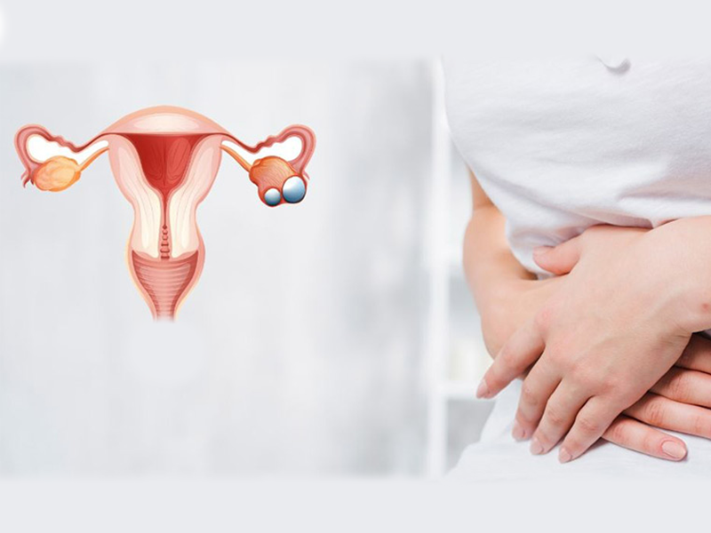 سندرم تخمدان پلی کیستیک یا "PCOS"