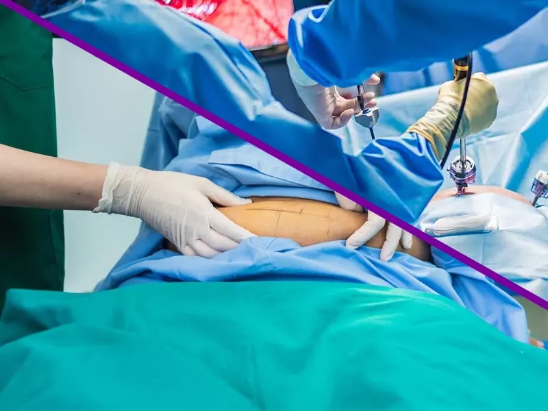 تفاوت لاپاراسکوپی و هیستروسکوپی