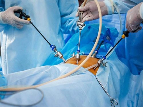 لاپاراسکوپی چیست