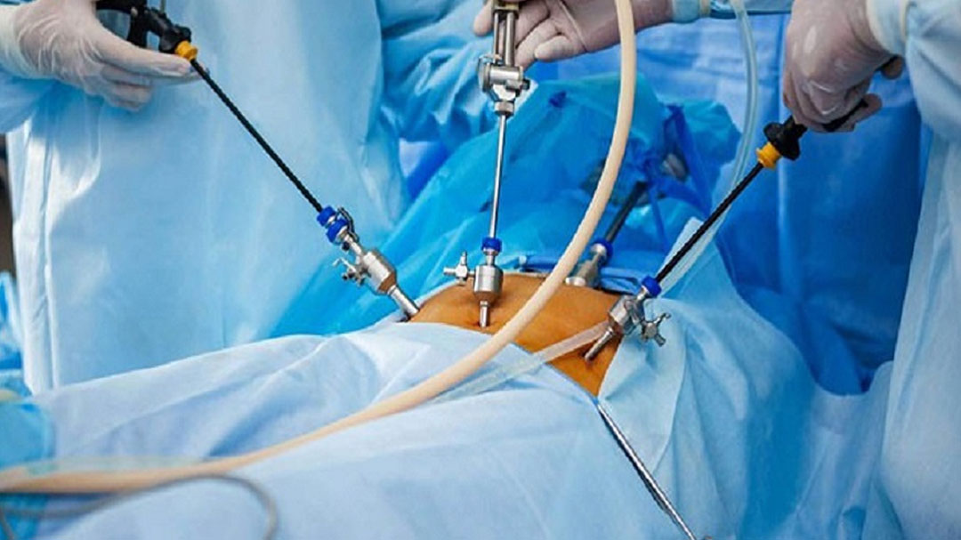 لاپاراسکوپی