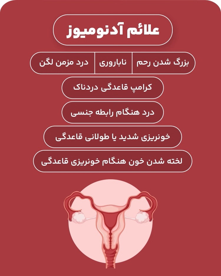 آدنومیوز چیست؟