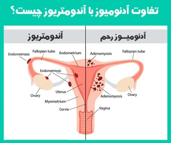 تفاوت بین آدنومیوز و اندومتریوز چیست؟